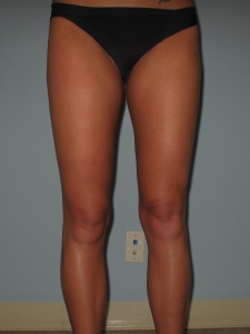 thighs anterior after-min