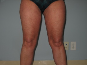 thighs anterior after-min