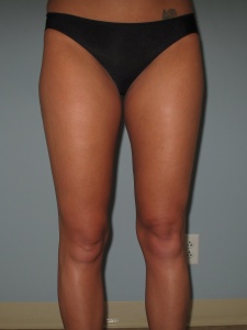 thighs anterior before-min