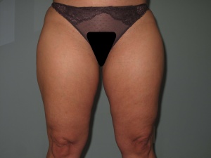 thighs anterior view before-min