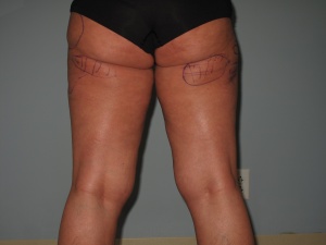 thighs posterior view before-min