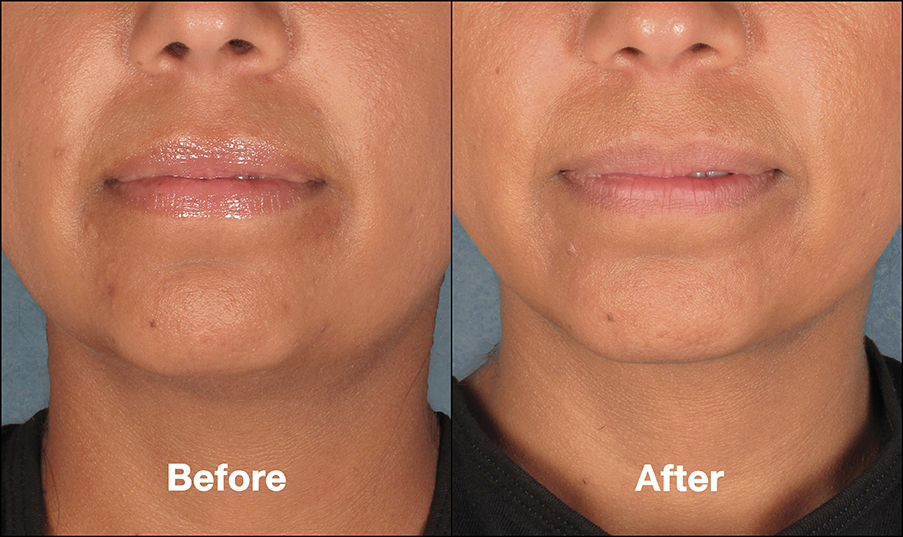 Front View of our St Louis Double Chin Treatment