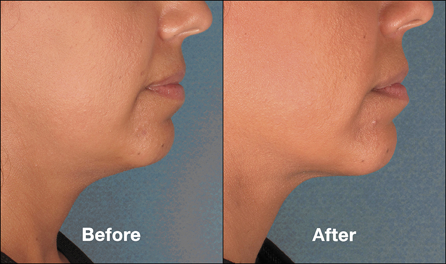 Results of our Incredible Double Chin Treatment