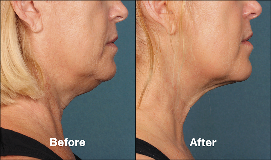 Side View of our Kybella - Before and After