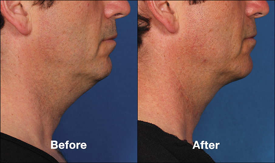 Kybella Double Chin Treatment Before and After