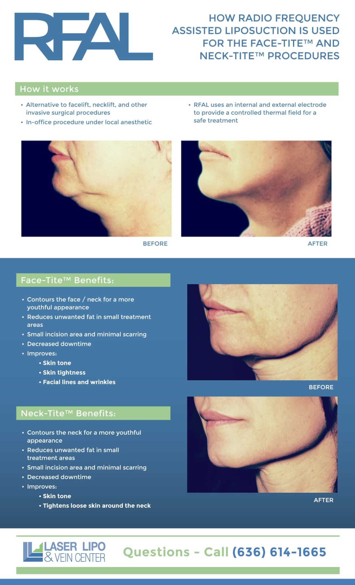 Infographic about skin tightening and liposuction on the neck