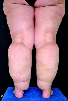 Picture showing lipedema's effect on the legs