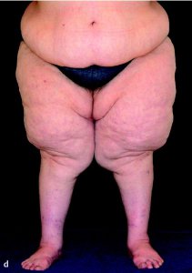 Picture of how lipedema unbalances the body