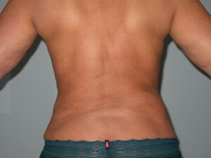 back bra line posterior after liposuction