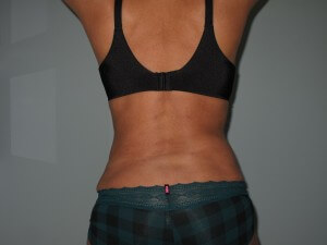 flanks braline tumescent liposuction after back