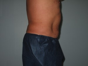 flanks right side after liposuction