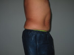 flanks right side before and after liposuction