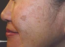 sun damage