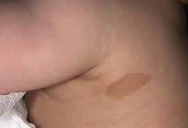 sun damage