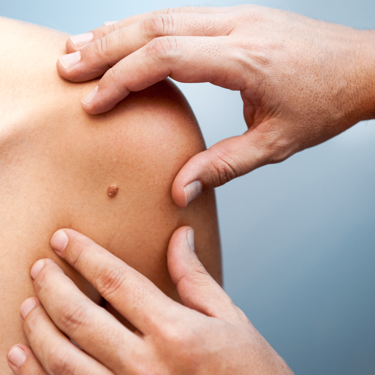 skin cancer