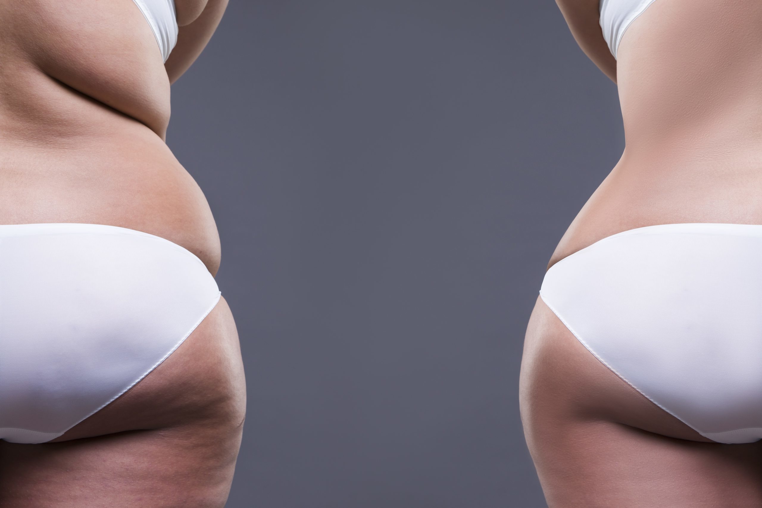 Liposuction procedures