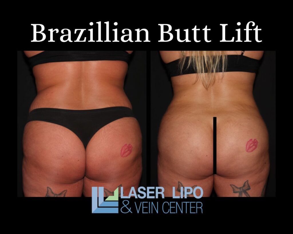 Brazillian Butt Lift St. Louis Laser Lipo and Vein2 1024x819