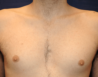 Chest After 1