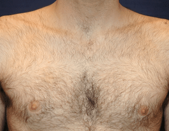 Chest Before 1