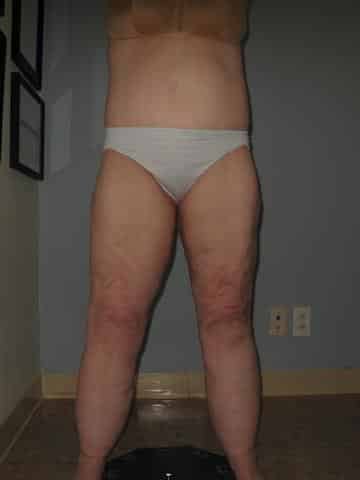 Early stage 2 lipedema 1 640