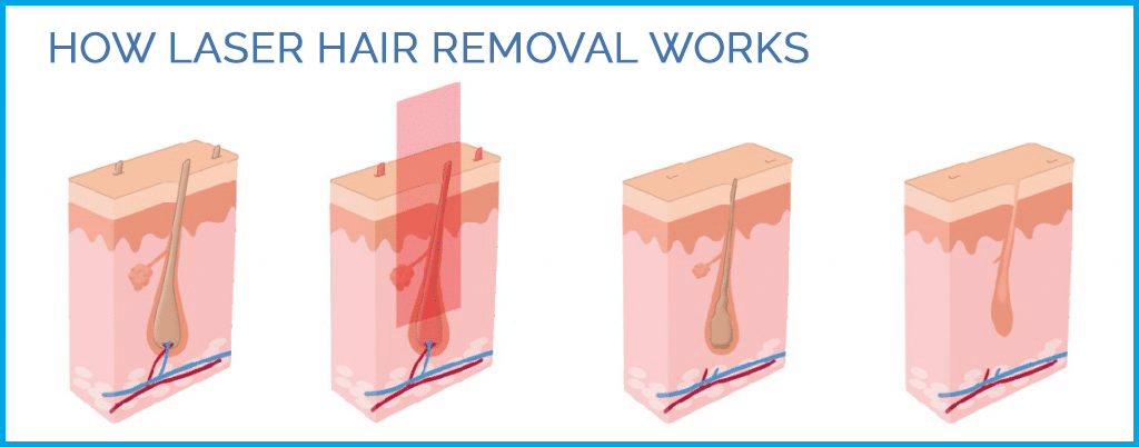 Hair Removal