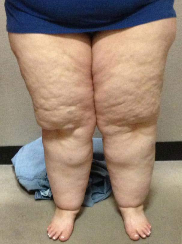 Lipoedema legs min