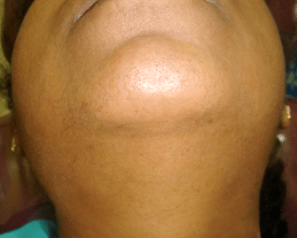 Neck After