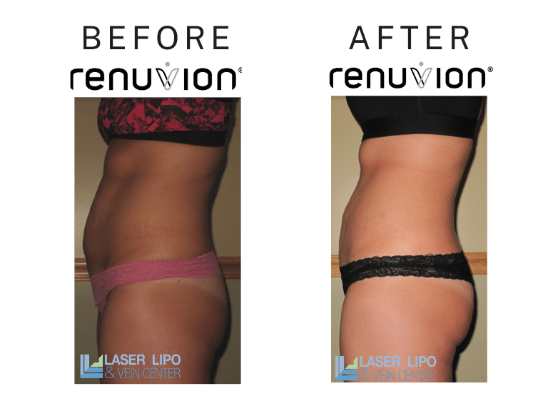 Before After Renuvion Woman Female St Louis Skin Tightening 2