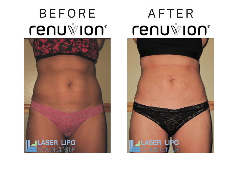 Before After Renuvion Woman Female St Louis Skin Tightening