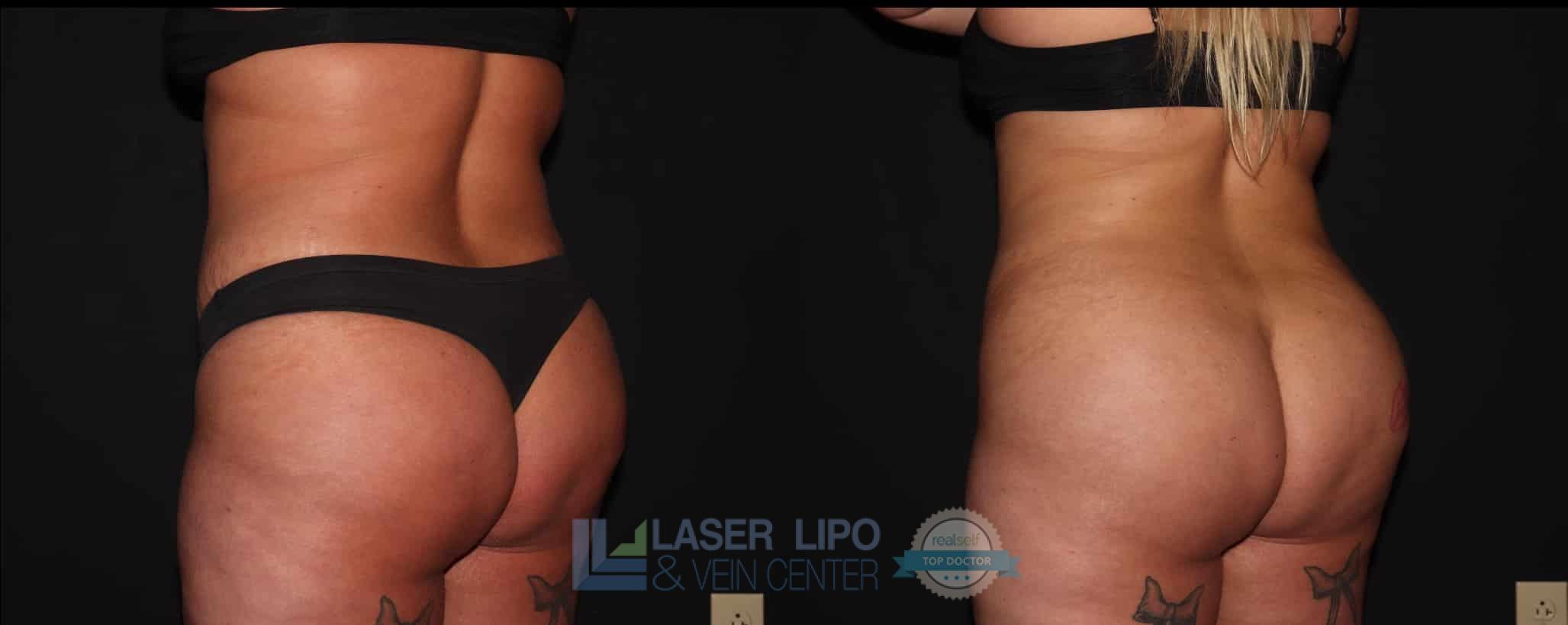 Before and After Image: BBL - left-back-oblique