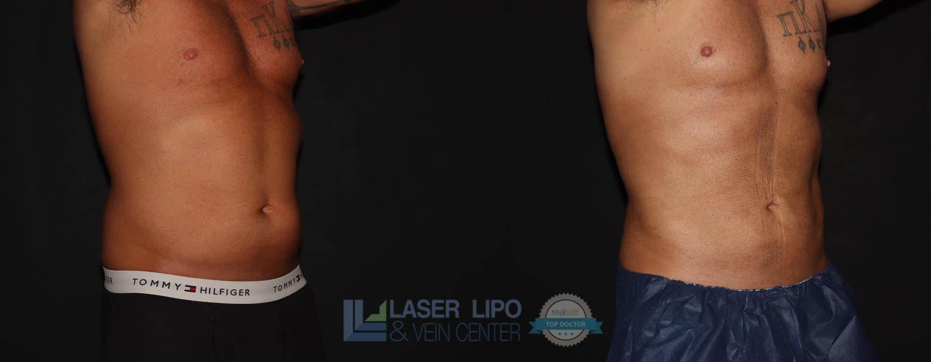 Before and After Image: Cosmetic Liposuction – Abs-Flanks - right-front-oblique