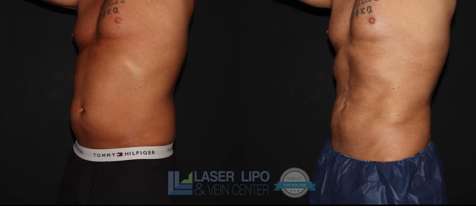 Before and After Image: Cosmetic Liposuction – Abs-Flanks - left-front-oblique