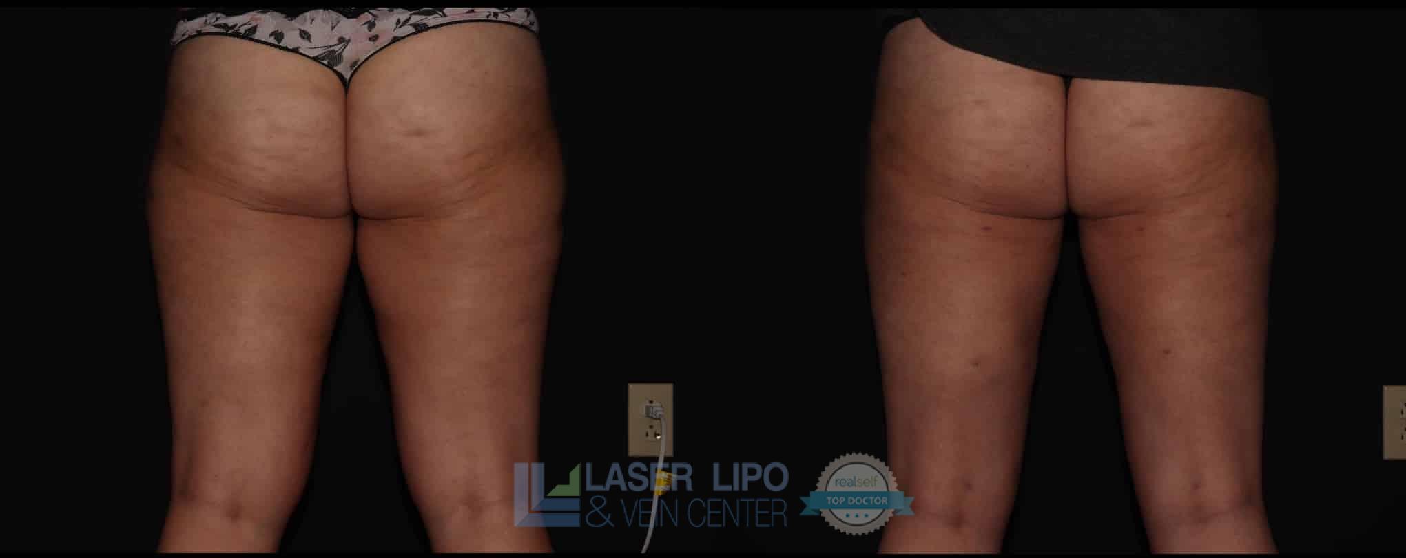 Before and After Image: Cosmetic Liposuction – Thighs - back