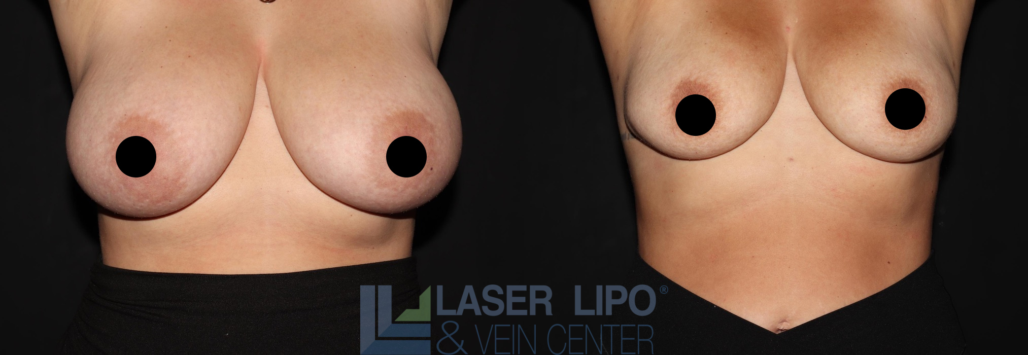 Before and After Image: Lipo/Renuvion to Breast - front
