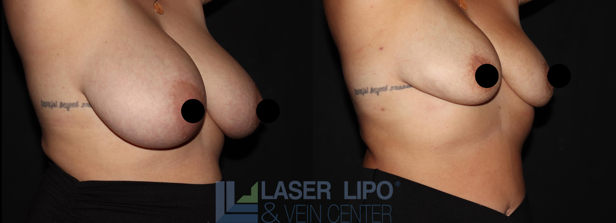 Before and After Image: Lipo/Renuvion to Breast - right-front-oblique