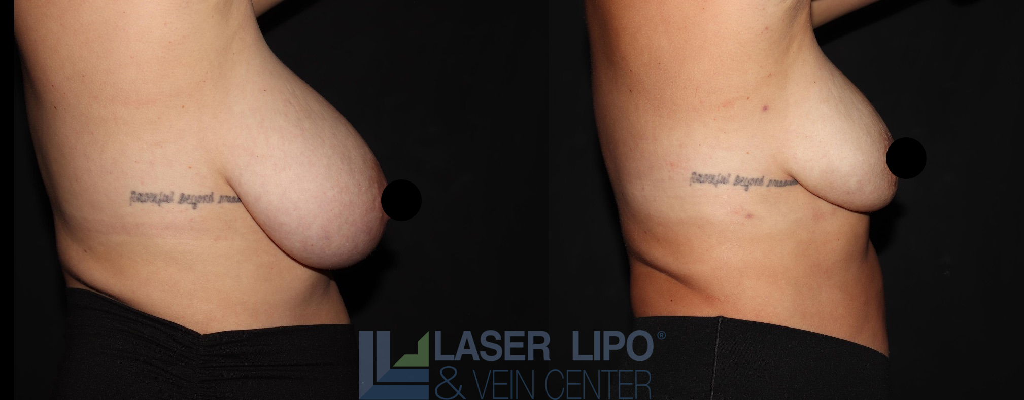 Before and After Image: Lipo/Renuvion to Breast - right-side