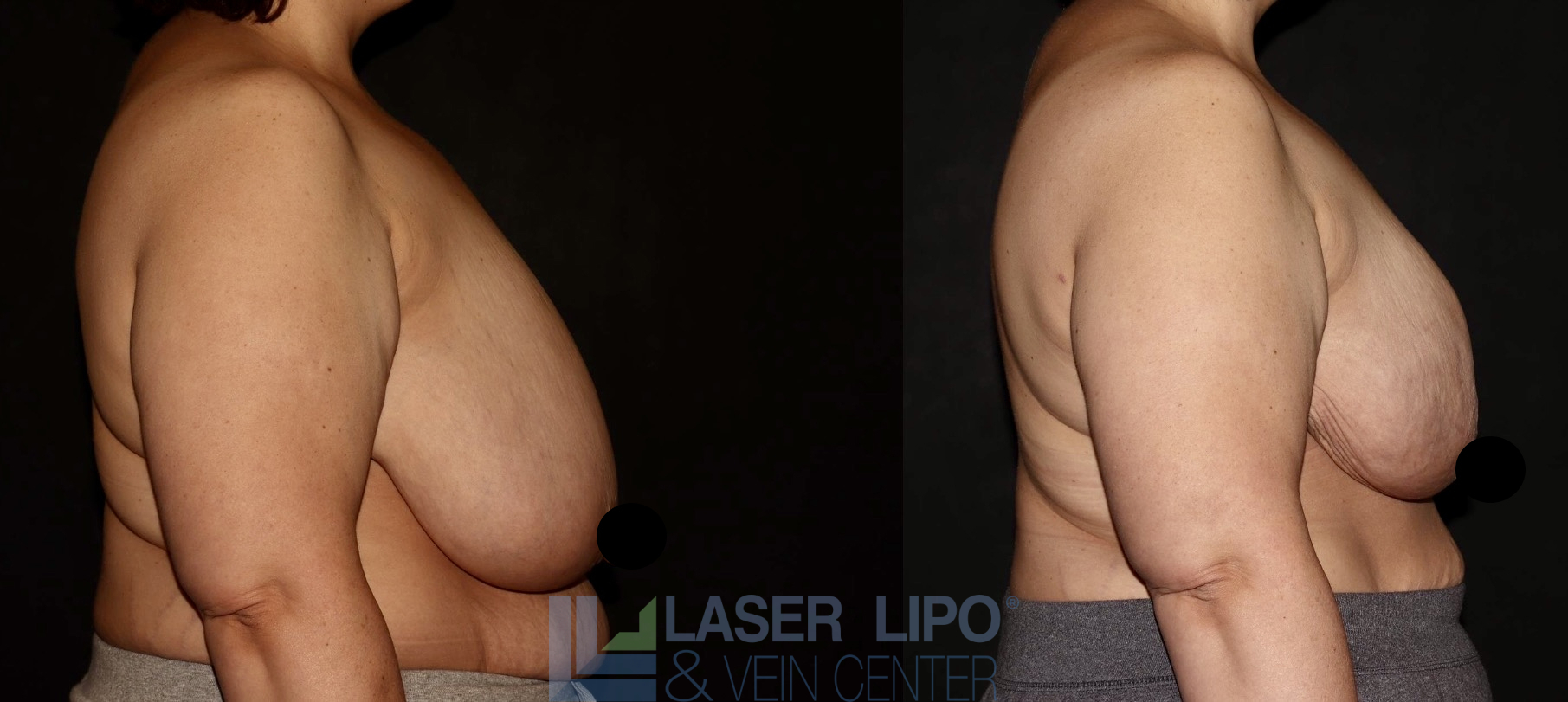 Before and After Image: Lipo/Renuvion to Breast - right-side