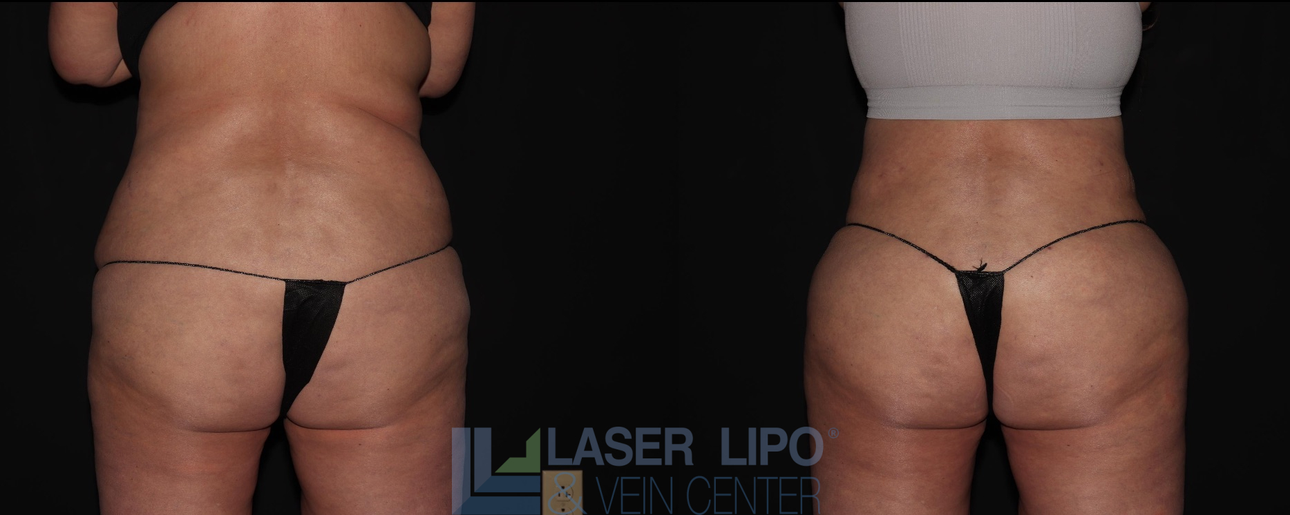 Before and After Image: Liposuction – Back