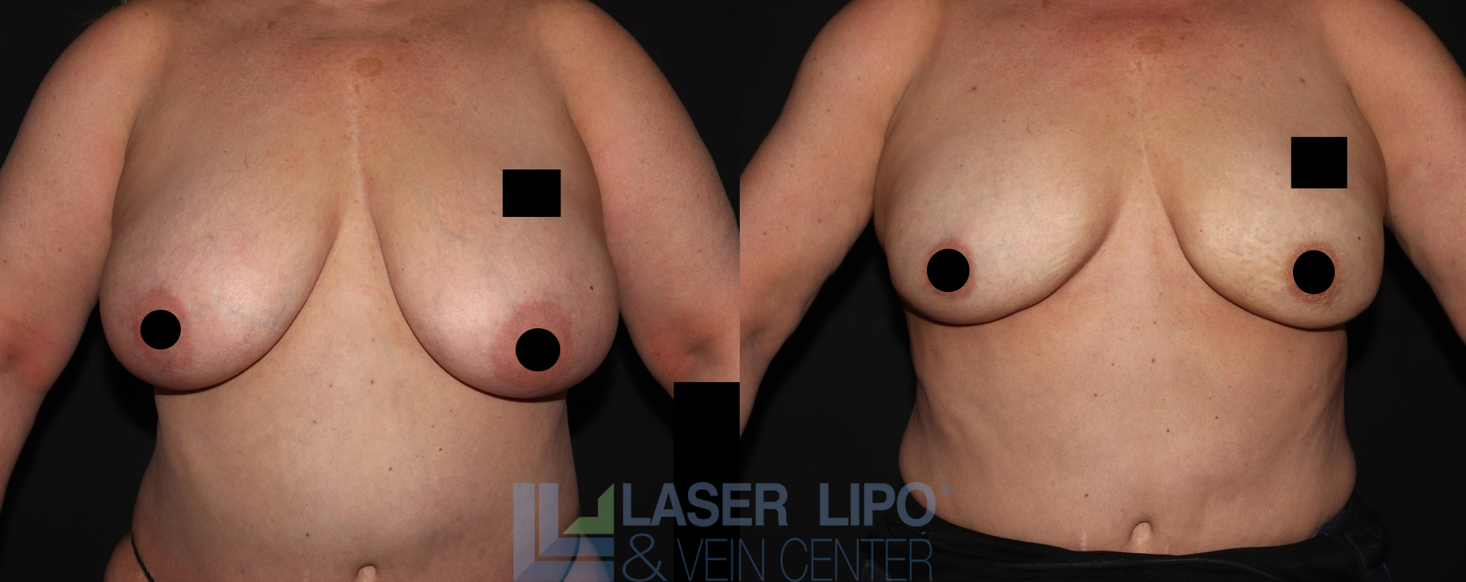 Before and After Image: Lipo/Renuvion to Breast