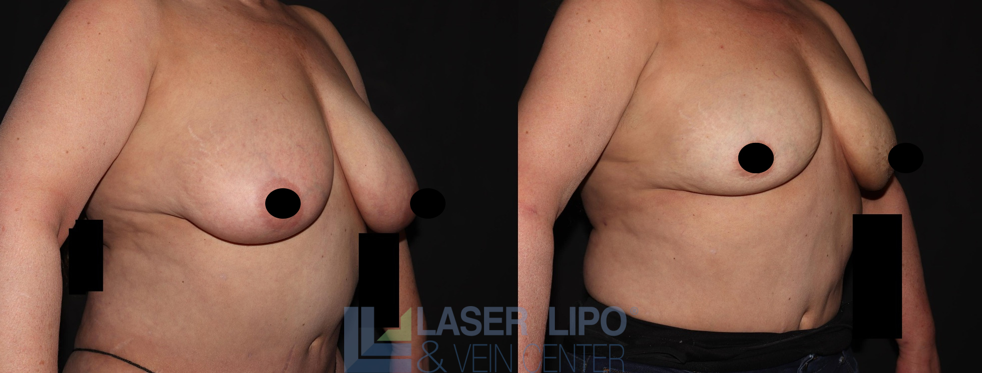 Before and After Image: Lipo/Renuvion to Breast - right-front-oblique