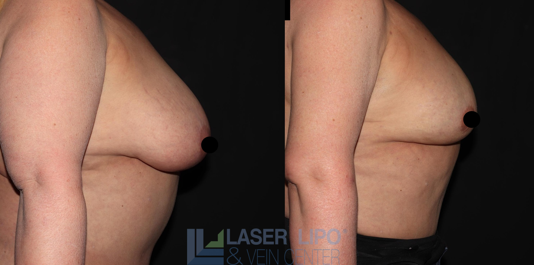 Before and After Image: Lipo/Renuvion to Breast - right-side
