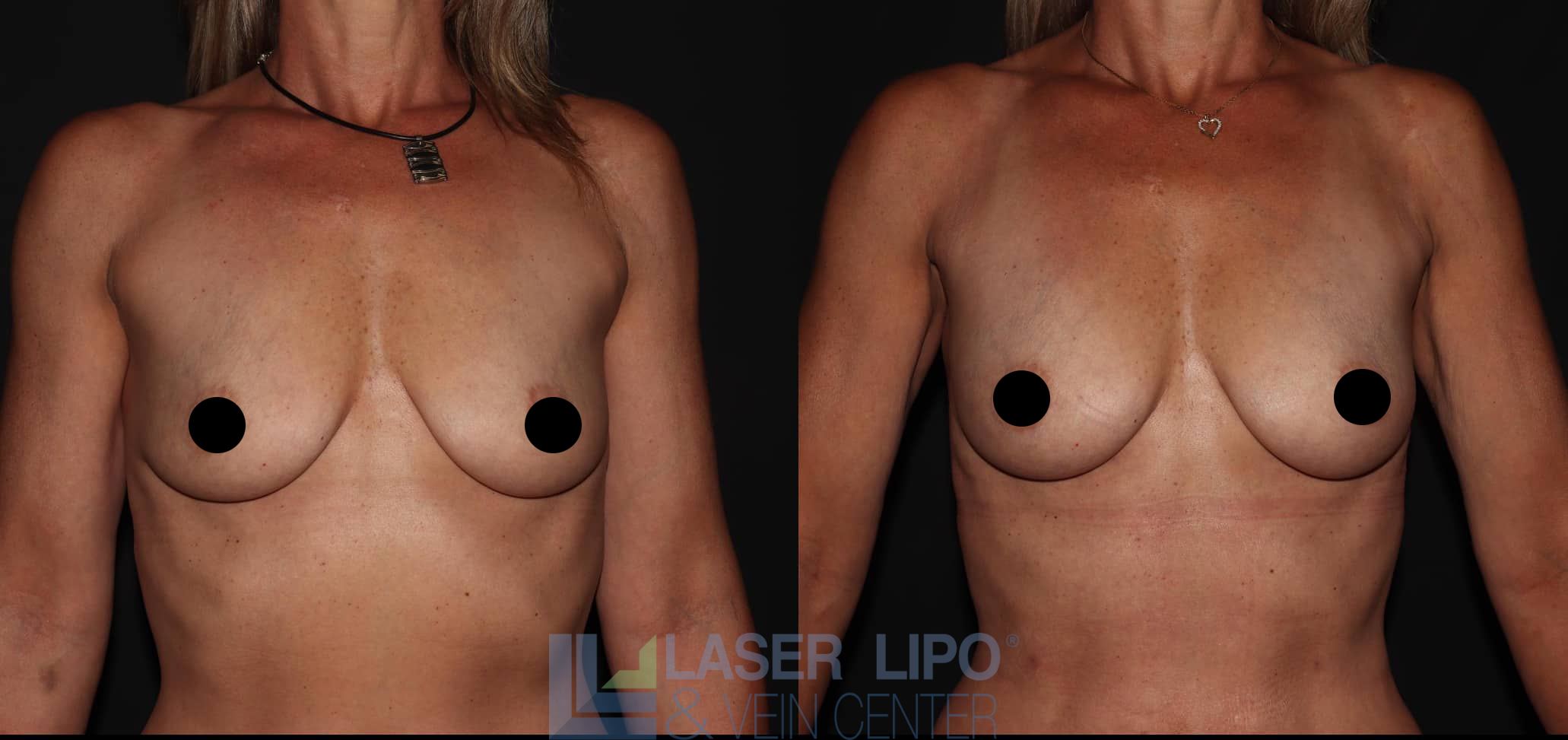 Before and After Image: Fat Transfer to Breast - front