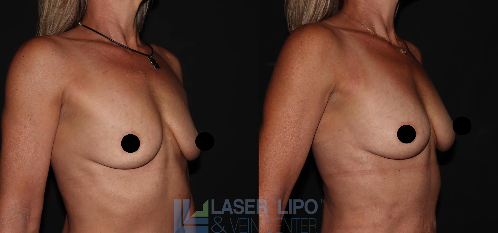 Before and After Image: Fat Transfer to Breast - right-front-oblique