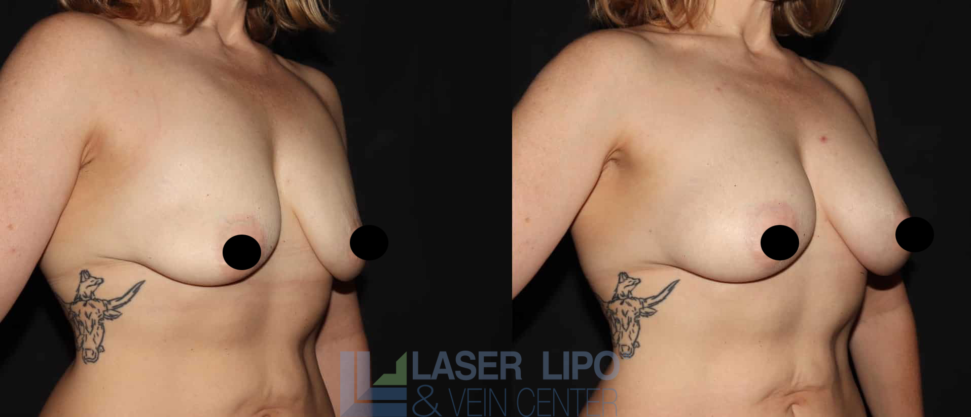 Before and After Image: Fat Transfer to Breast - right-front-oblique