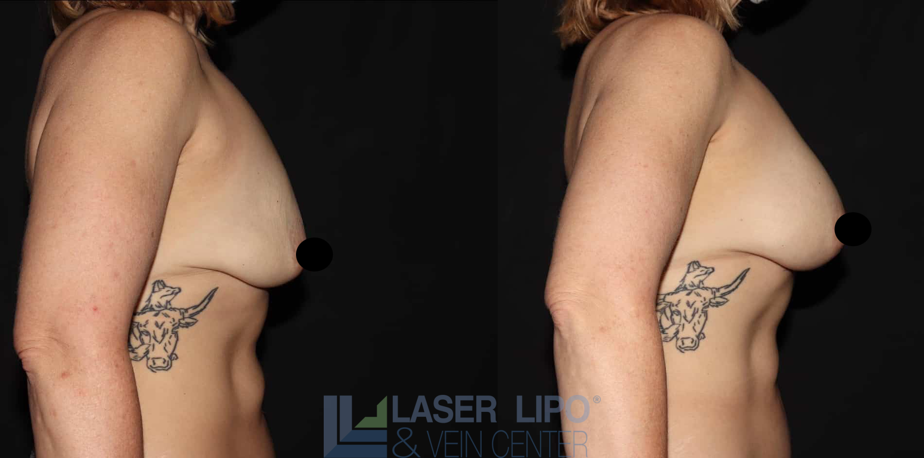 Before and After Image: Fat Transfer to Breast - right-side