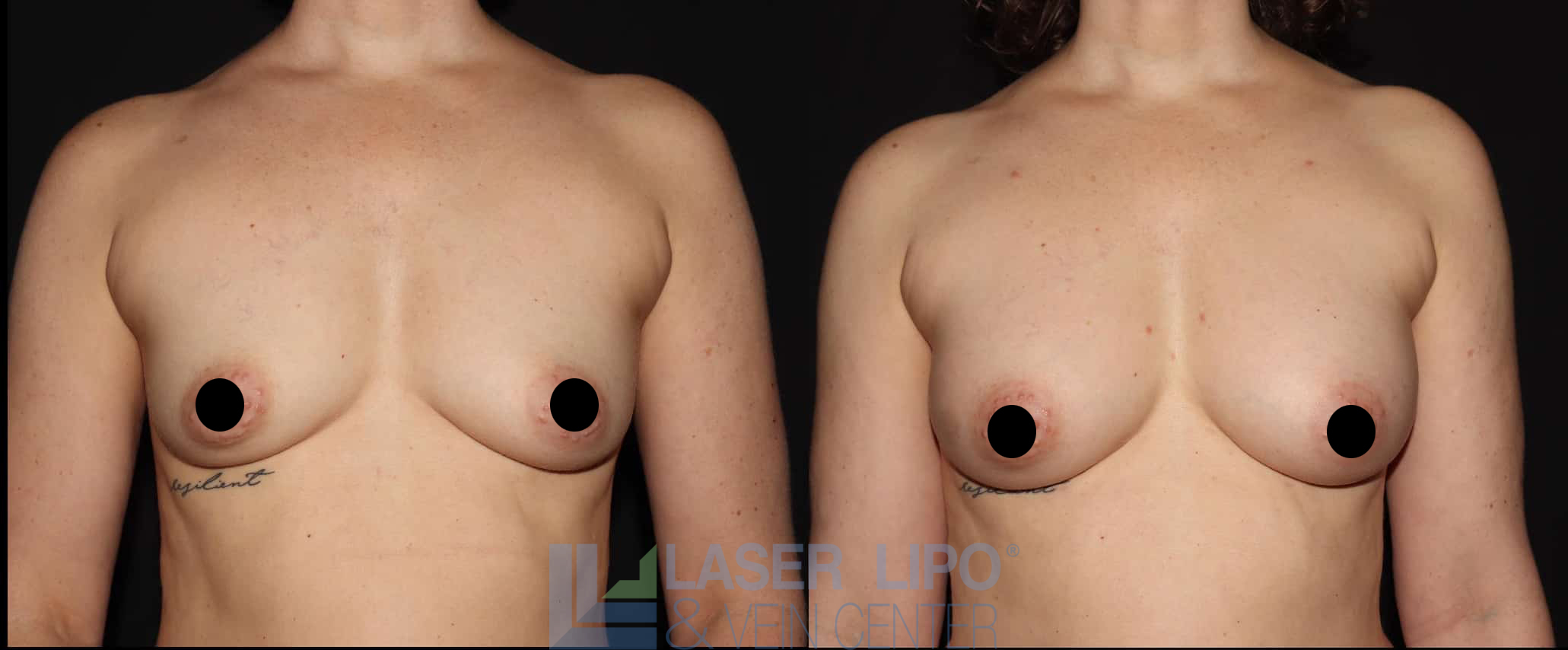 Before and After Image: Fat Transfer to Breast - front
