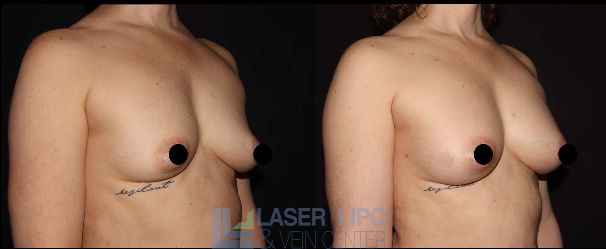 Before and After Image: Fat Transfer to Breast - right-front-oblique