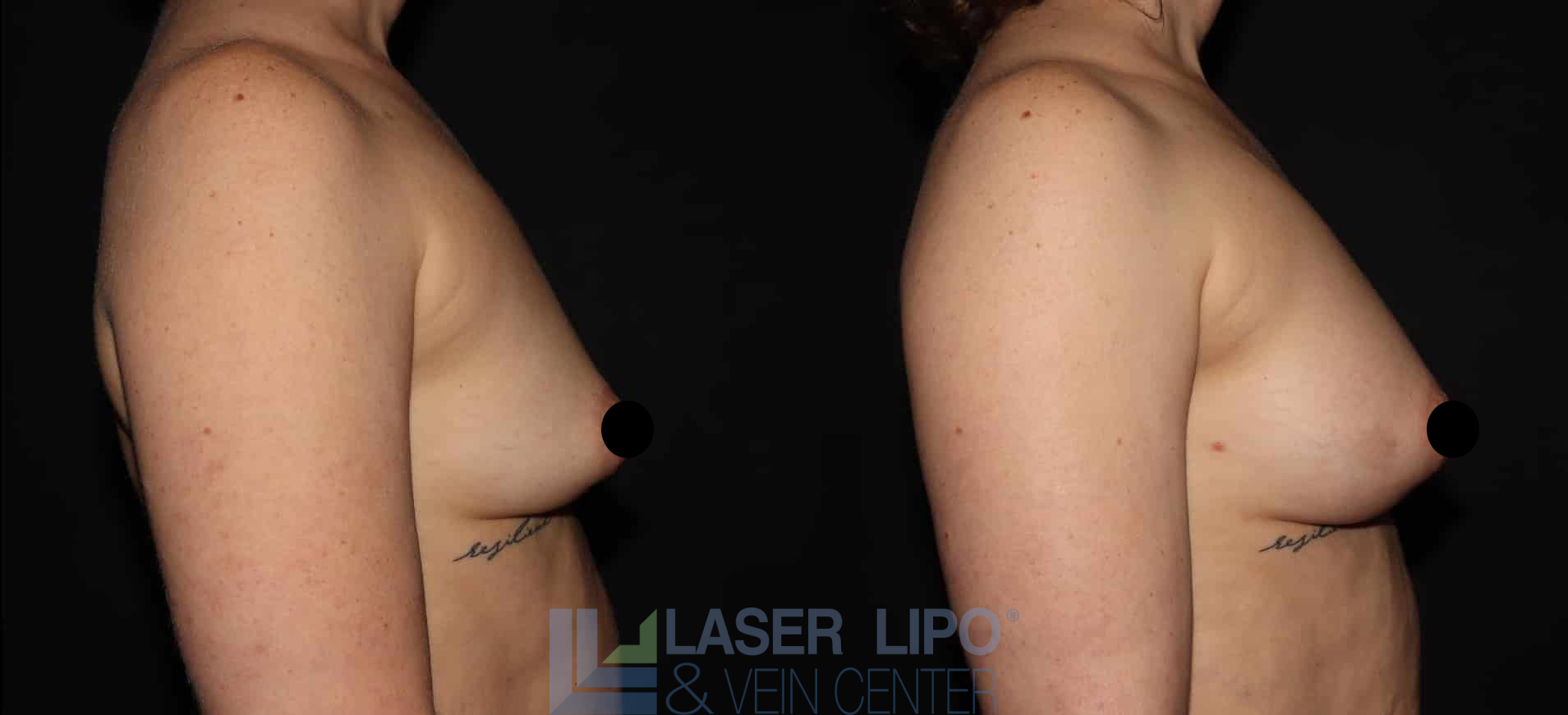 Before and After Image: Fat Transfer to Breast - right-side