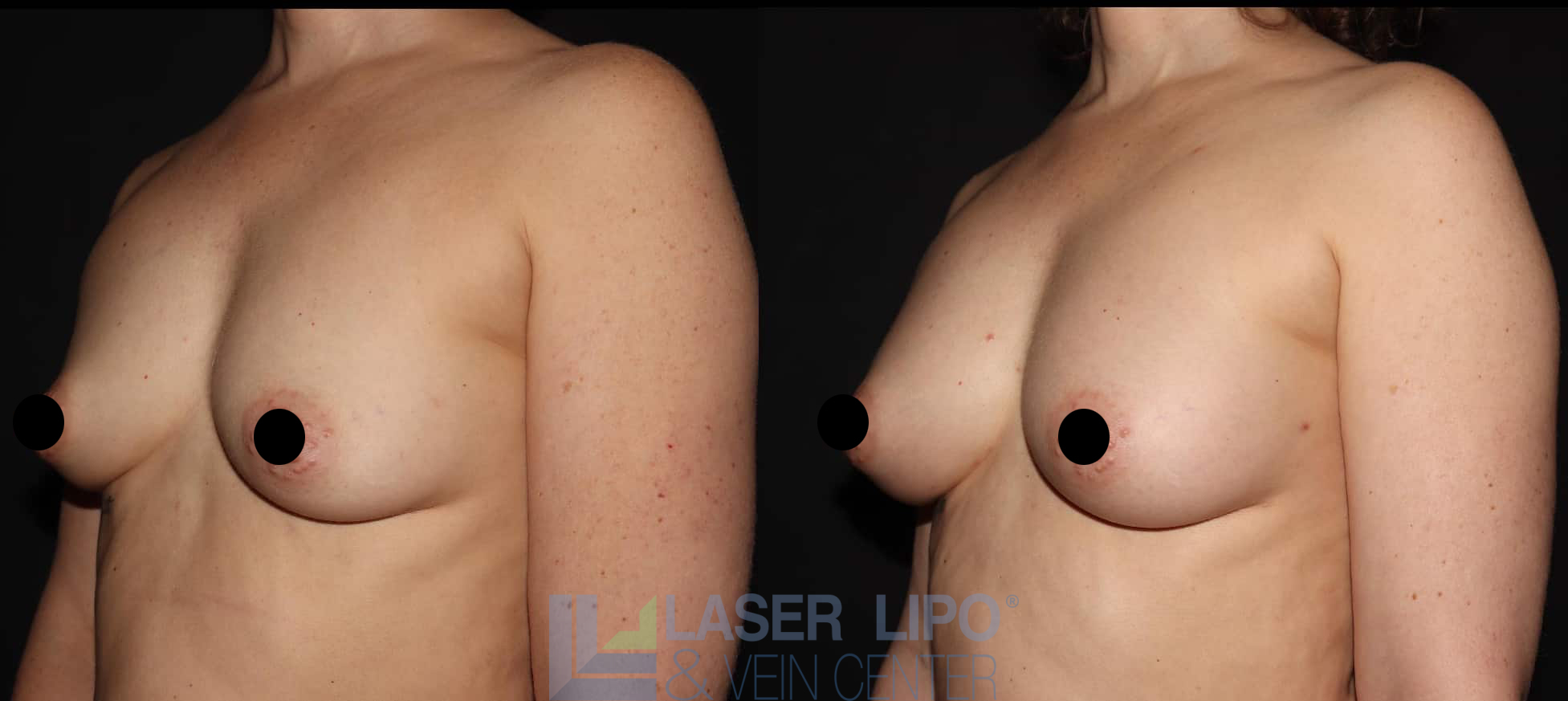 Before and After Image: Fat Transfer to Breast - left-front-oblique
