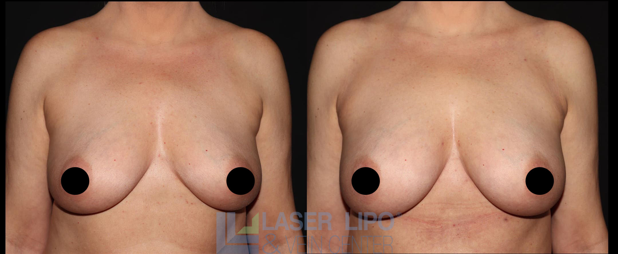 Before and After Image: Fat Transfer to Breast - front
